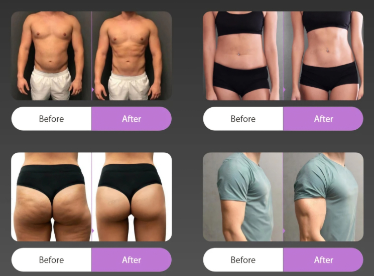 emszero body contouring machine treatment results